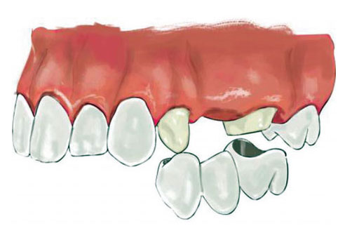 1.1. Introduction to Fixed Dentures